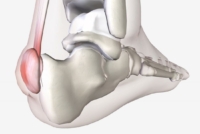 síndrome o enfermedad de haglund fisiodual fisioterapia y osteopatia